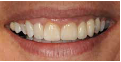 Jonathan Schofield publishes on Implants in the Aesthetic Zone