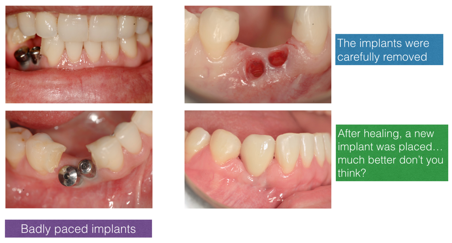 Correction of Bad Implants The Dental Implant Clinic