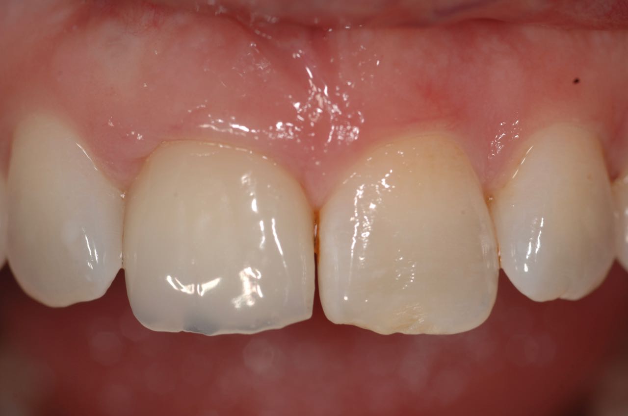 Close up of completed dental implant with crown