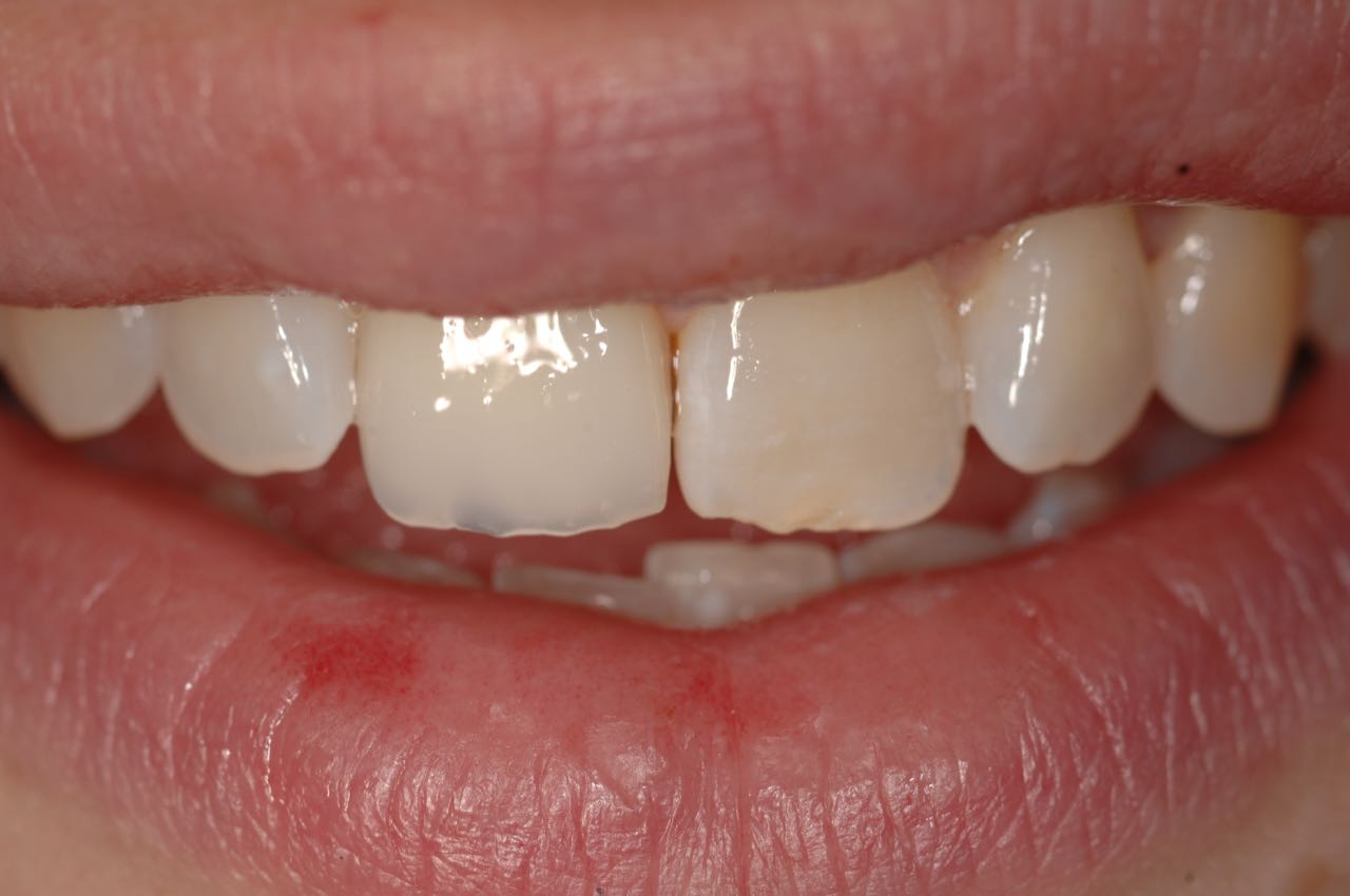 Mouth showing completed dental implant with crown