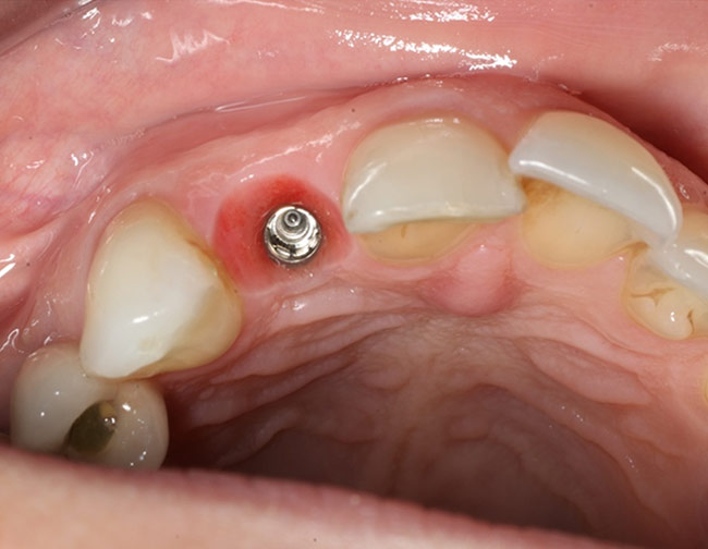 Dental implant at UR2