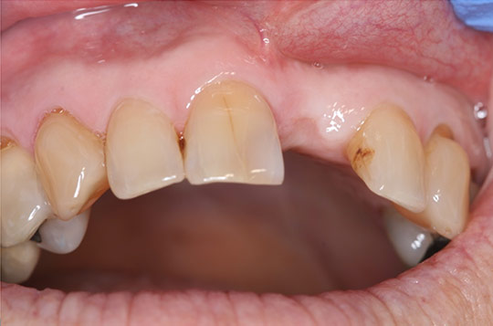 Open mouth showing missing tooth prior to dental implant