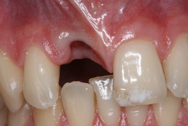 Close up of missing tooth with bone loss requiring dental implant