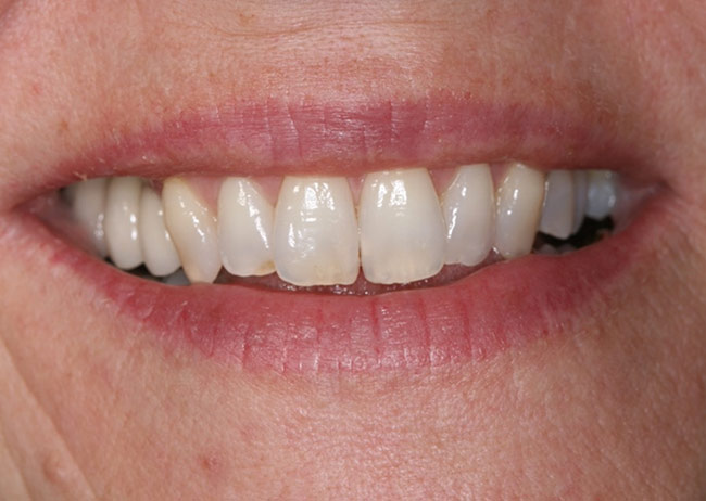 Perfect smile with dental implants at back teeth