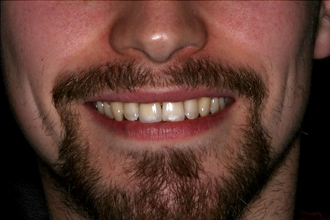 Man smiling showing off dental implant at UR1