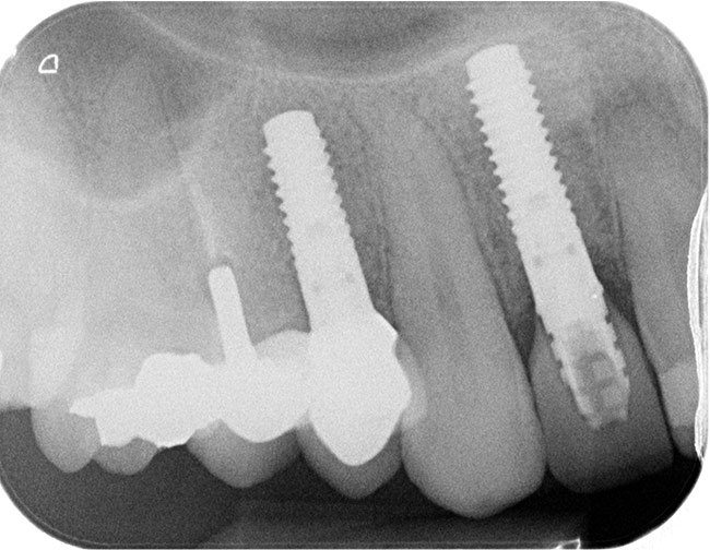 X ray showing two dental implants at positions UR2 and UR4