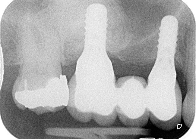 Xray showing sinus graft during dental implant procedure