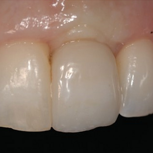 Close up of dental implant with crown