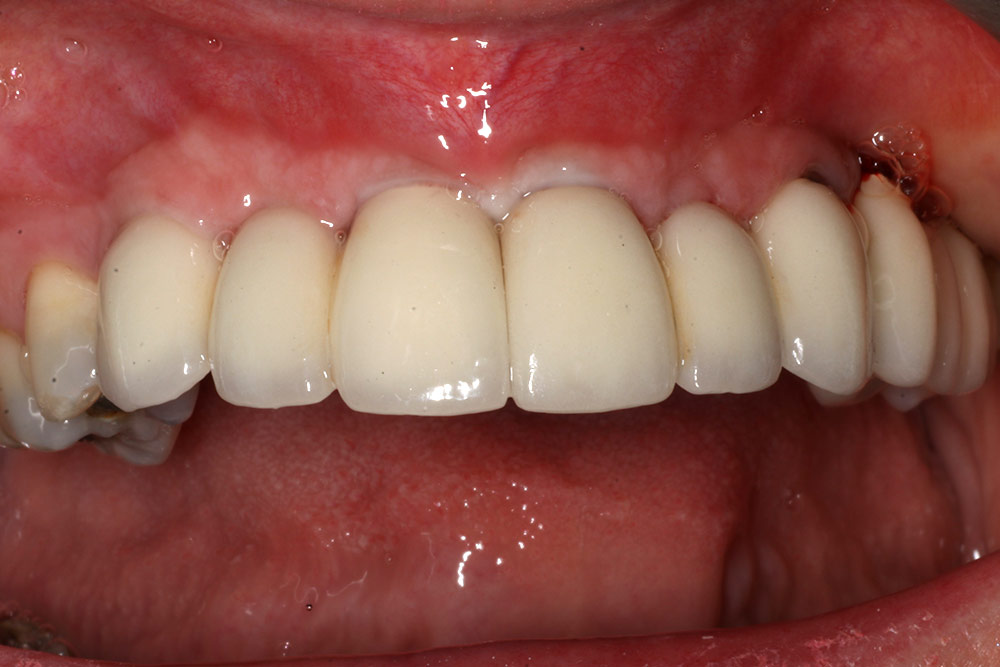 Finished dental implants at our Bath practice retaining a fixed bridge