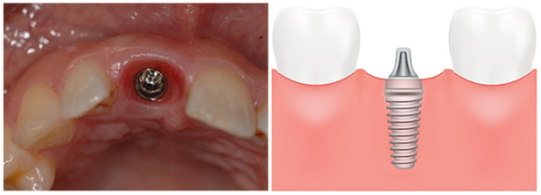 photograph of dental implant awaiting crown, alongside illustration
