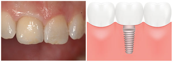 photograph of dental implant and crown, alongside illustration