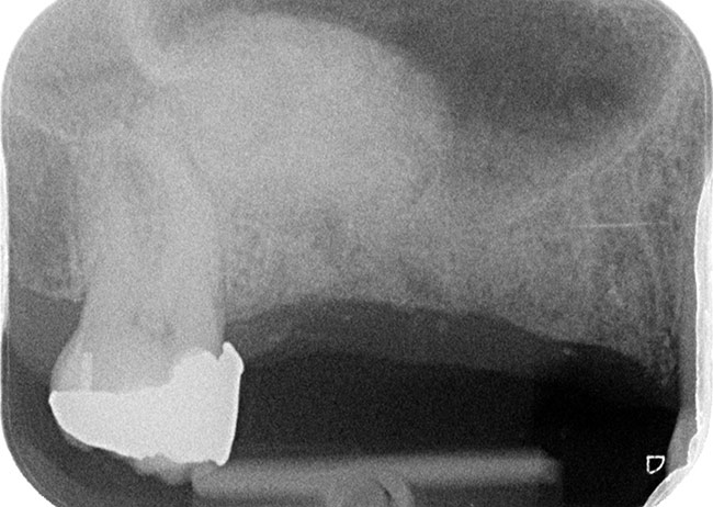 X-ray showing sinus lift during dental implant procedure