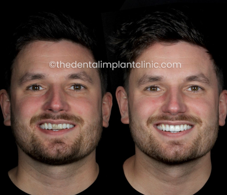Composite Bonding Case