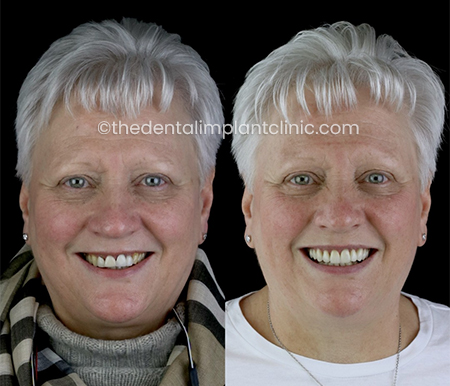 Composite Bonding Case