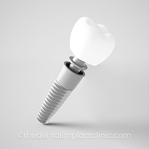 Implant