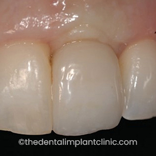 Implant After