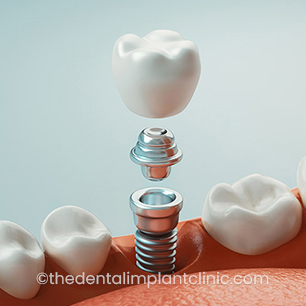 Implant Before