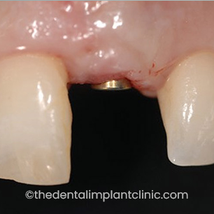 Implant before