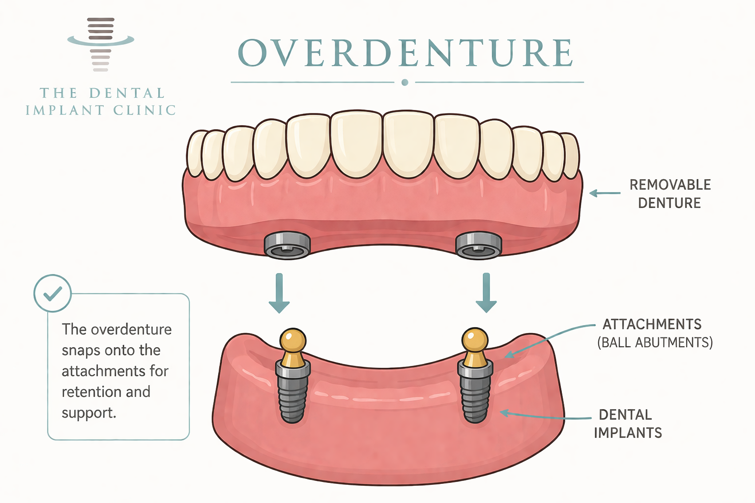 Overdenture